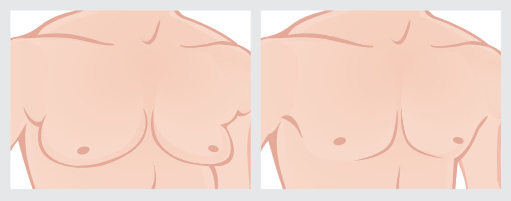 gynecomastia post-op visits