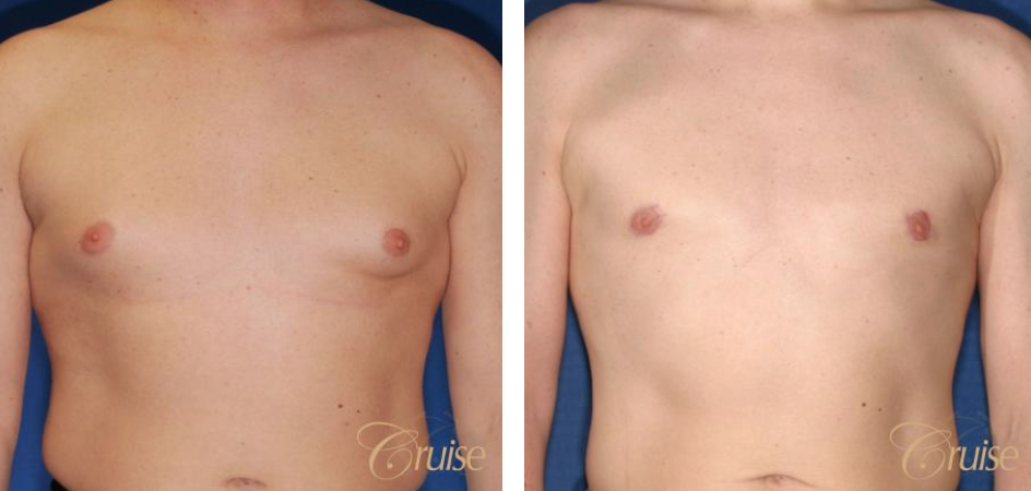 Puffy Nipple - LA Gynecomastia