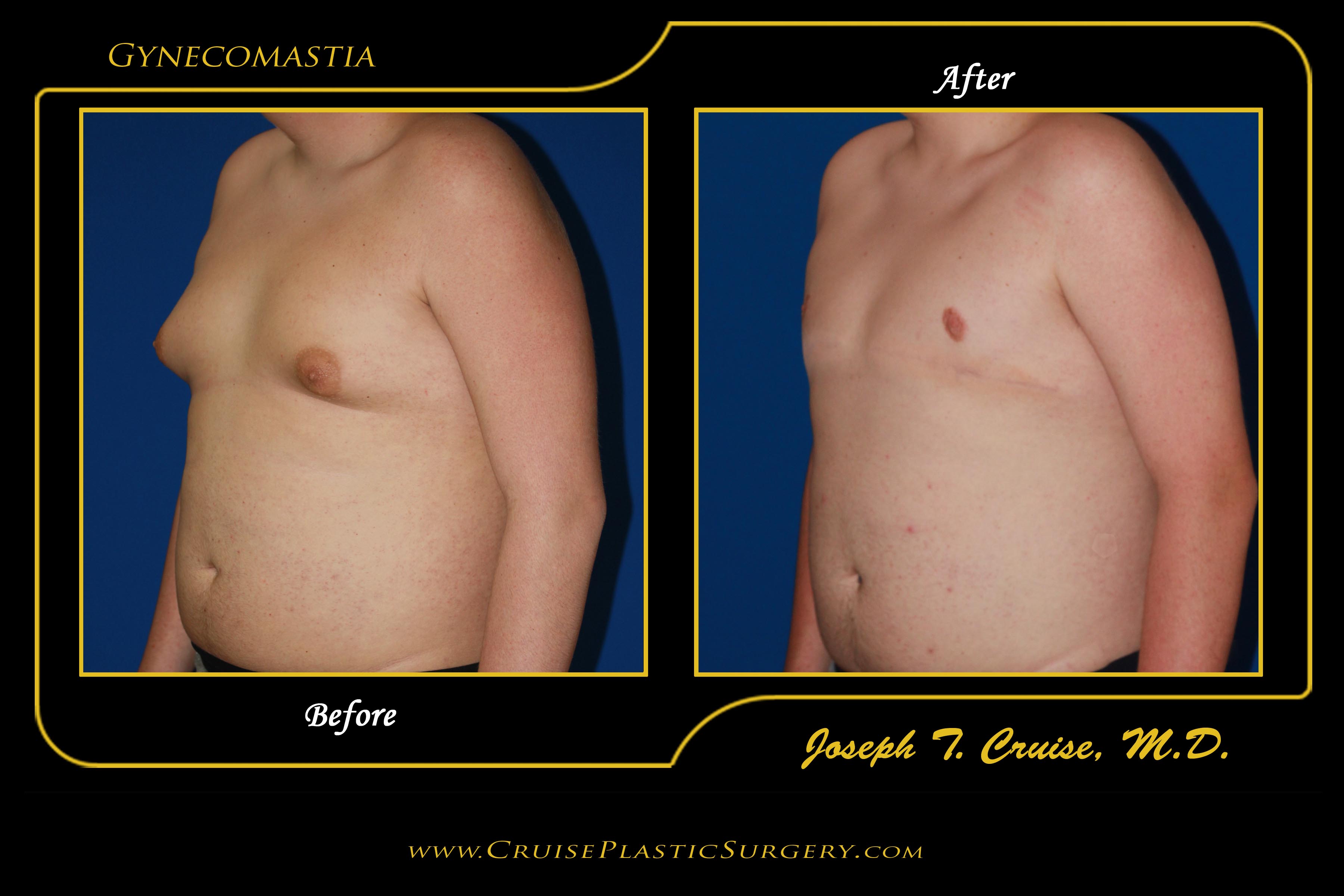 gynaecomastia before after