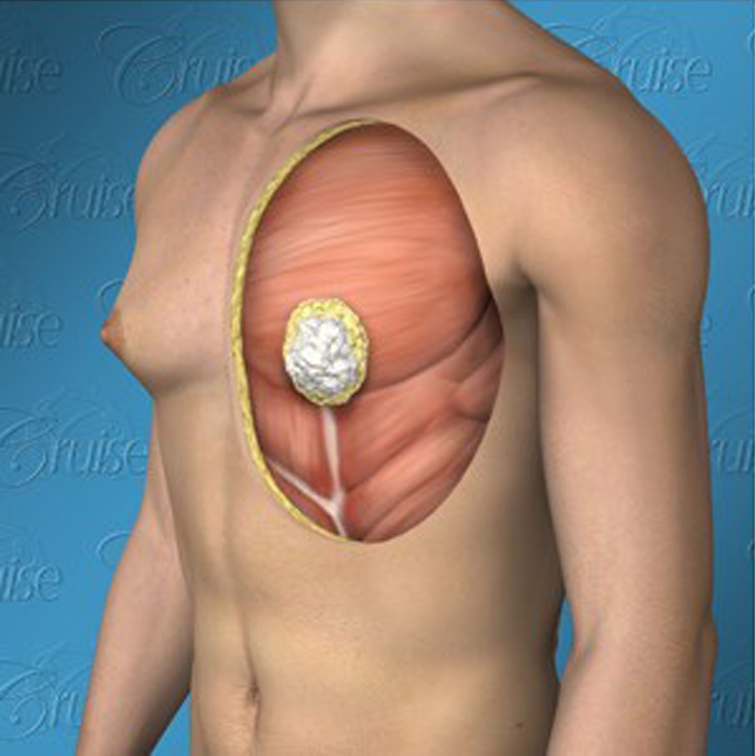 How To Get Rid Of Puffy Nipples Or Type 1 Gynecomastia?