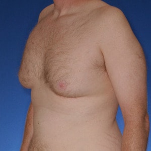 Gynecomastia types classified by Dr. Cruise