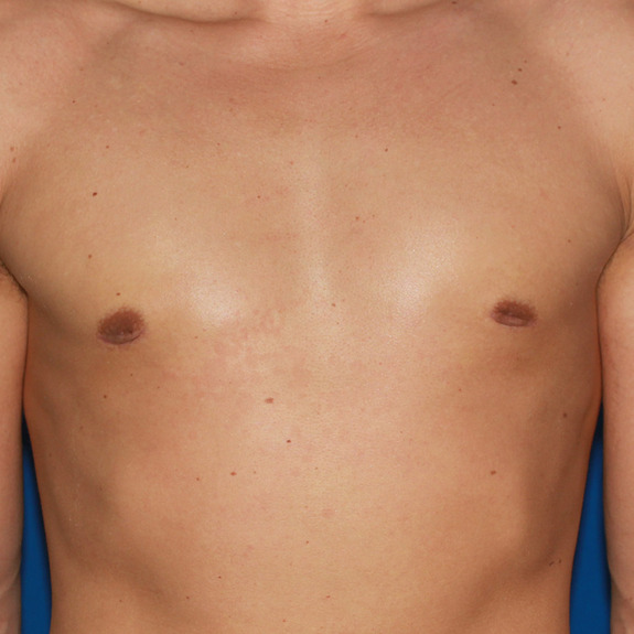 Why Does My Gynecomastia Look Better When It's Cold?
