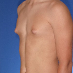 Puffy Nipple - LA Gynecomastia