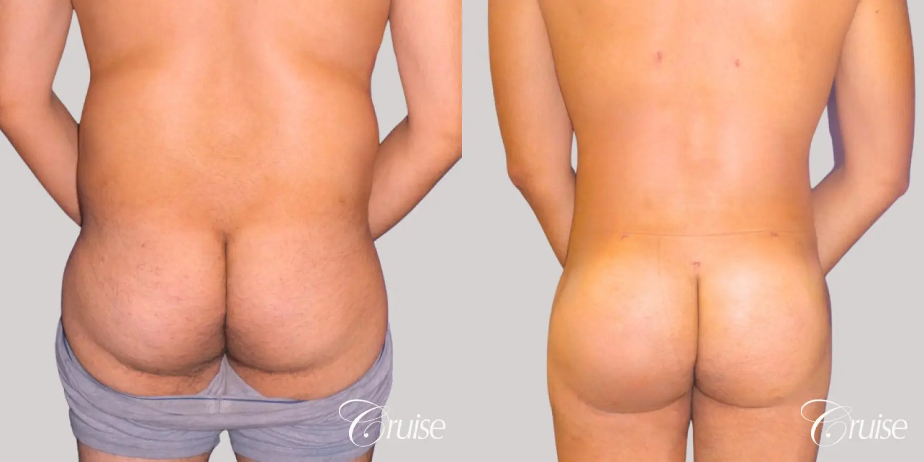 brazilian-butt-lift-before-and-after-1eb7471O3ULu_highres