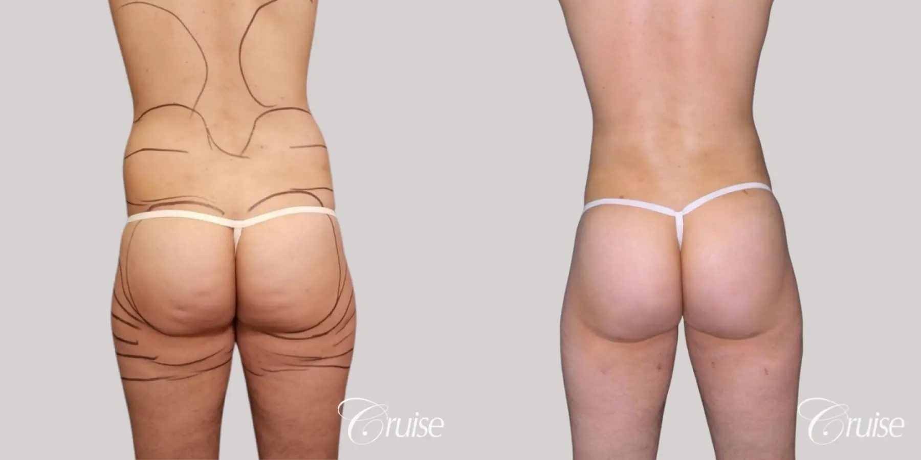 brazilian-butt-lift-before-and-after-50z749C5A75B_highres