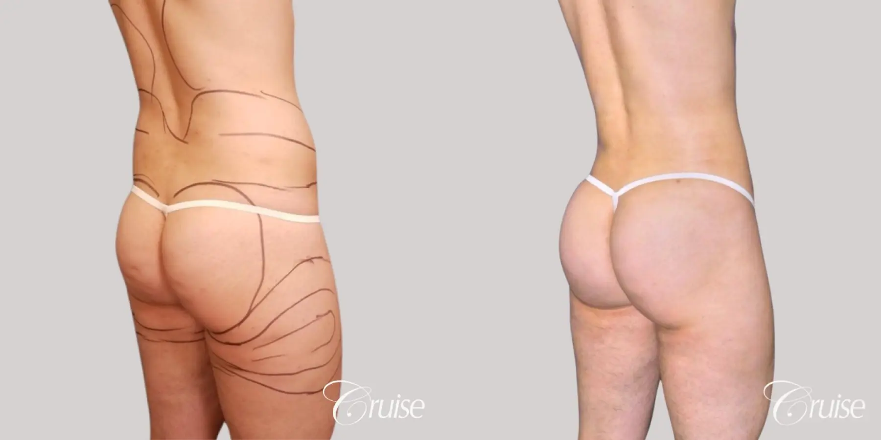 brazilian-butt-lift-before-and-after-x9OlsUNVOsxv_highres