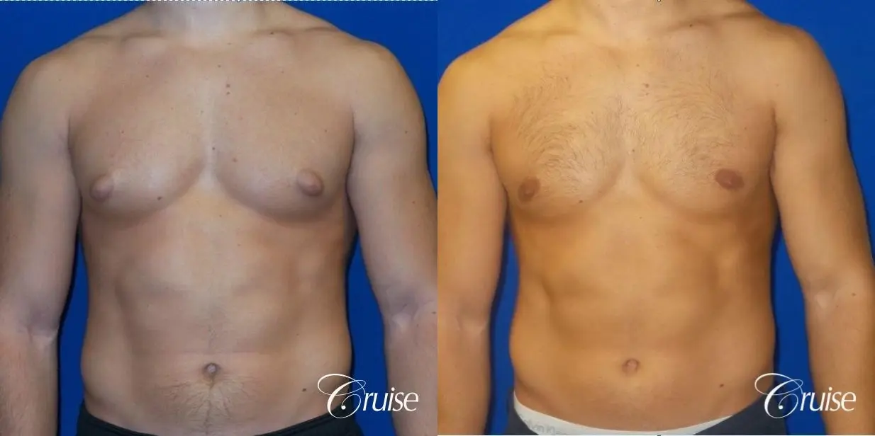 gynecomastia-before-and-after-5Mqo9wqOiM6G_highres