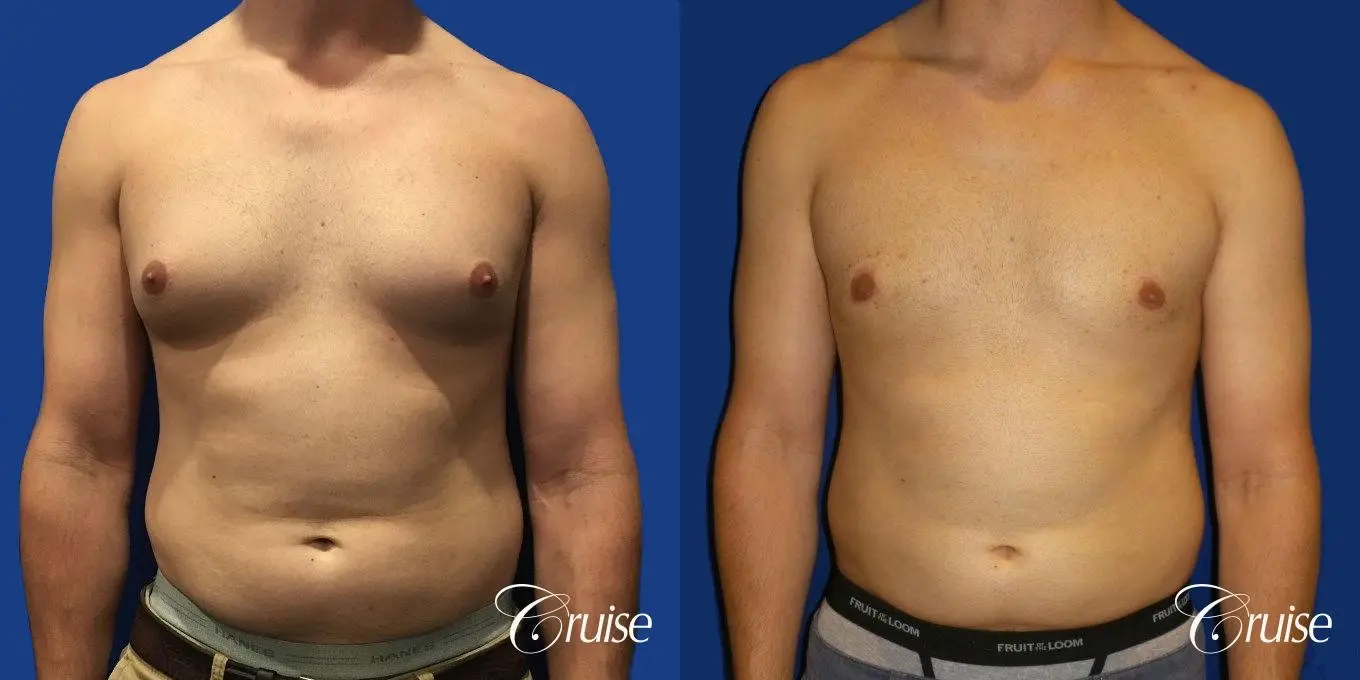 gynecomastia-before-and-after-7xVwpqv2c1Zm_highres