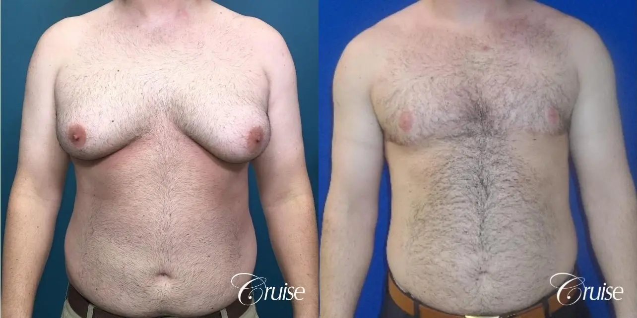 gynecomastia-before-and-after-LcRaai2PD5v0_highres