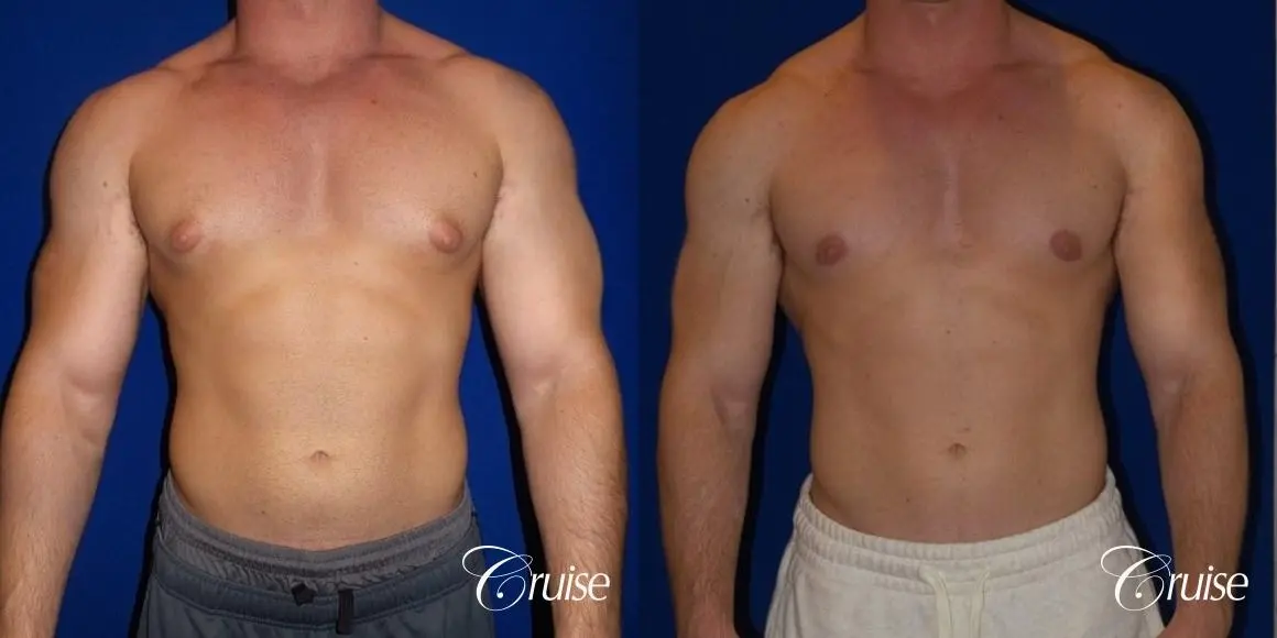 gynecomastia-before-and-after-eT2zMjNbe0V4_highres