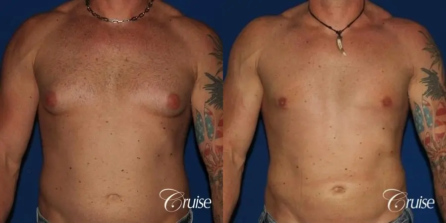 gynecomastia-before-and-after-sMQLl3v5WAmZ_highres